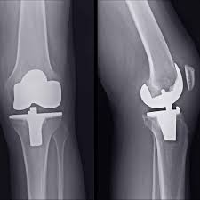 total knee replacement md west one