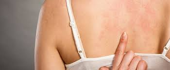 how can i treat an eczema rash afc