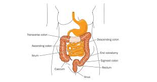 colectomy surgery for ibd ibdrelief