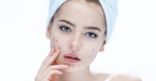 beauty tips for getting rid of acne