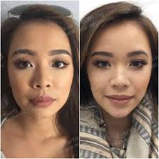 By using fillers we can enhance the volume of your face. A Guide To Cosmetic Facial Sculpting Cheek Chin Jawline Lips Nose