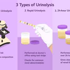 Urinalysis Uses Side Effects Procedure Results