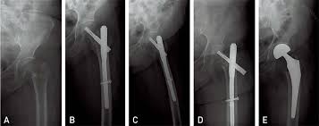 intertrochanteric fracture of the femur