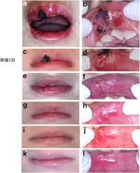 healing of open upper lip vermillion