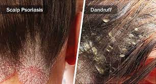 scalp psoriasis vs dandruff how to