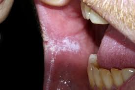 leukoplakia nhs