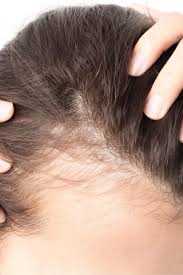 It's a similar condition to male pattern baldness, but the hair loss and thinning follow a different pattern. Female Pattern Baldness Causes Treatment And Prevention