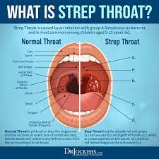 strep throat symptoms and 15 natural