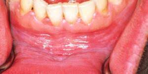 mouth cancer pictures what