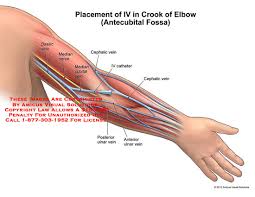 Placement Of Iv In Crook Of Elbow Antecubital Fossa