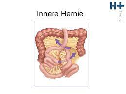 Hernias usually occur in the groin, stomach, or belly button. Bariatrische Und Metabolische Chirurgie Und Was Bedeutet Es