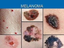 melanoma image