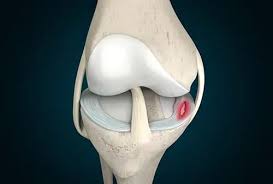 meniscus tear for dearborn and livonia