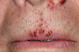 cold sores on the upper lip stock
