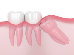 wisdom tooth pain warning signs