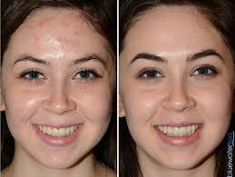 laser treatment of acne fine lines