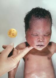 There are currently 178 eyelid surgery + epicanthal folds questions and doctor answers on realself. Down Syndrome Article