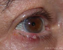 moran core what is a stye and how do