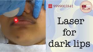 laser for dark lips lip lightening