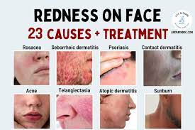 redness on face 23 causes and how to
