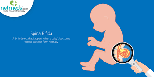spina bifida causes diagnosis