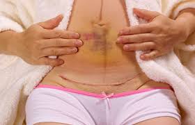 what are the 3 types of surgery scars