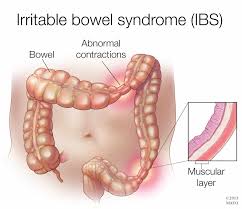 Home Remedies Irritable Bowel Syndrome Mayo Clinic News