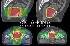 options for prostate cancer oklahoma