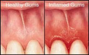 floss your teeth even if your gums bleed