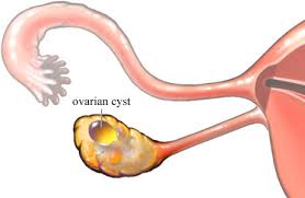 ovarian cyst international women s clinic