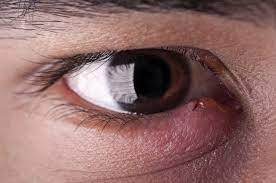 p on the eyelid types symptoms