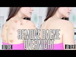 how to get rid of back acne overnight