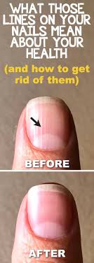 what those vertical lines on your nails