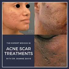 acne scar treatments the expert weighs