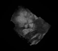 Wann ist ein 3d ultraschall am interessantesten? 3d Ultraschall Wikipedia