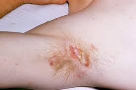 Ingrown pubic hair cyst can really be disturbing and annoying at the same time. Hidradenitis Suppurativa Hs Nhs
