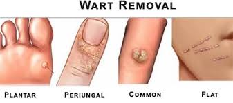 warts naturally wart symptoms