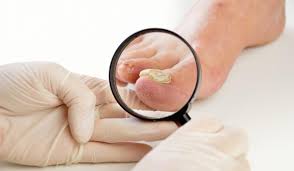 nail diseases types symptoms