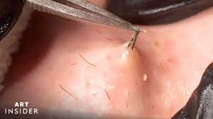 how ingrown hairs are removed art