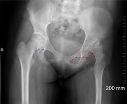 Pelvic anatomy mri variant anatomy pelvic viscera. Assessment Of The Young Adult Hip Joint Using Plain Radiographs Springerlink