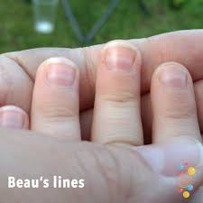 beau s lines skin deep