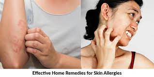 home remes for skin allergies