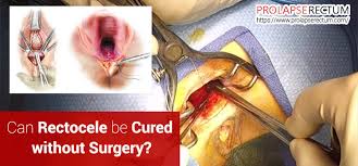 can rectocele be cured without surgery
