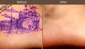 tattoo removal nyc birthmark removal