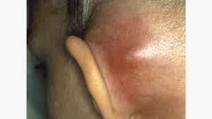 p or lump in or around the ear