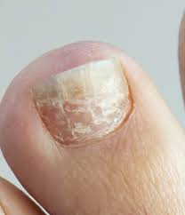 what are horizontal lines on toenails