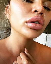 chrissy teigen says swollen lips aren t