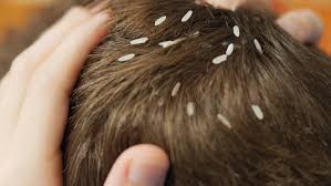 get rid of head lice naturally 12 home