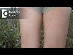 inner thigh rashes in agers