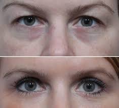 eyelid surgery blepharoplasty and eye